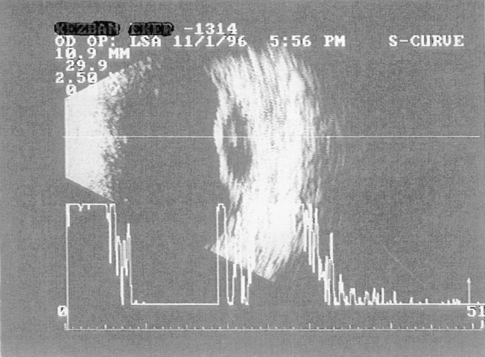 26 Jpn J Ophthalmol Vol 43: 25 30, 1999 igure 1. B-scan echogram showing dome-shaped melanoma (case 5). igure 2. Mushroom-shaped melanoma demonstrating internal sound attenuation at base (case 2).