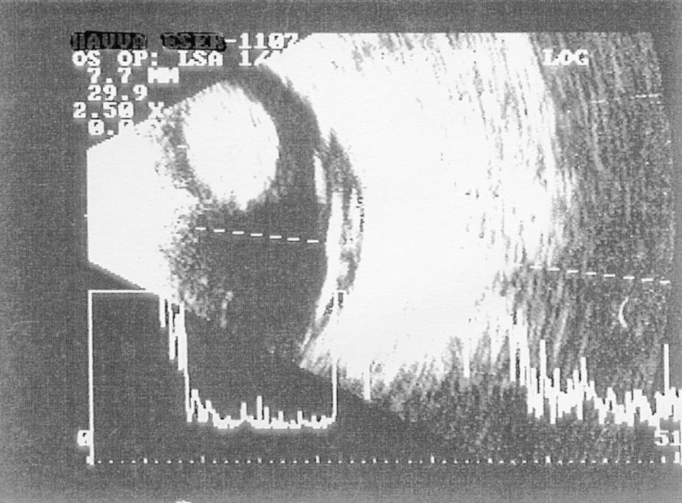 B-scan echography showed typical findings of an uveal melanoma including acoustic quiet zone, choroidal excavation, and orbital shadowing (igure 1).
