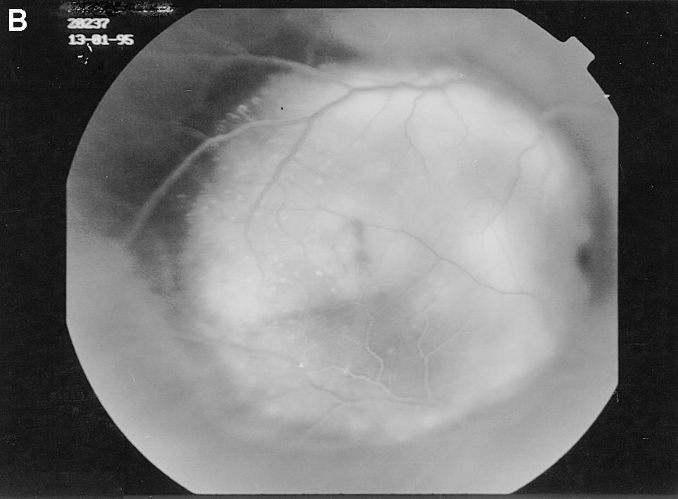 5 I125 plaque, laser RD: Retinal detachment; VA: Visual acuity. igure 3.