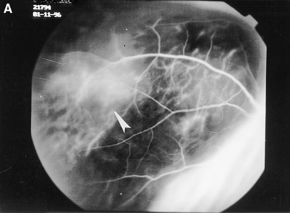 28 Jpn J Ophthalmol Vol 43: 25 30, 1999 igure 5. Mid-venous phase of fluorescein angiography of a mushroom-shaped choroidal melanoma demonstrating double circulation (case 2).