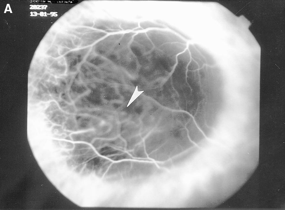 L.S. ATMACA ET AL. ICG VIDEOANGIOGRAPHY O CHOROIDAL MELANOMAS 29 igure 8. Late phase indocyanine green angiography at 33 minutes showing a three-ring pattern (case 4). igure 7.