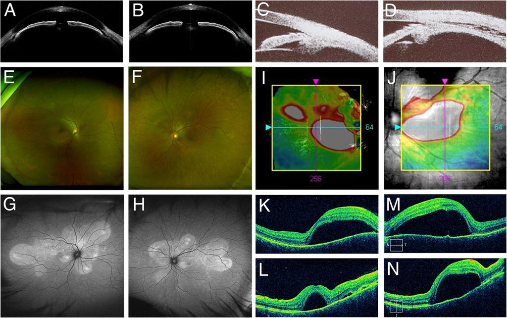 Kurobe et al. Journal of Ophthalmic Inflammation and Infection (2017) 7:16 right and left eyes, respectively.