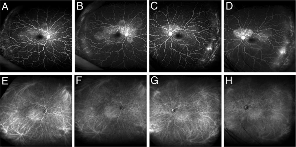 Kurobe et al. Journal of Ophthalmic Inflammation and Infection (2017) 7:16 Page 3 of 6 Fig. 2 Baseline wide-field angiography findings using Optos California. a d Fluorescein angiograms.