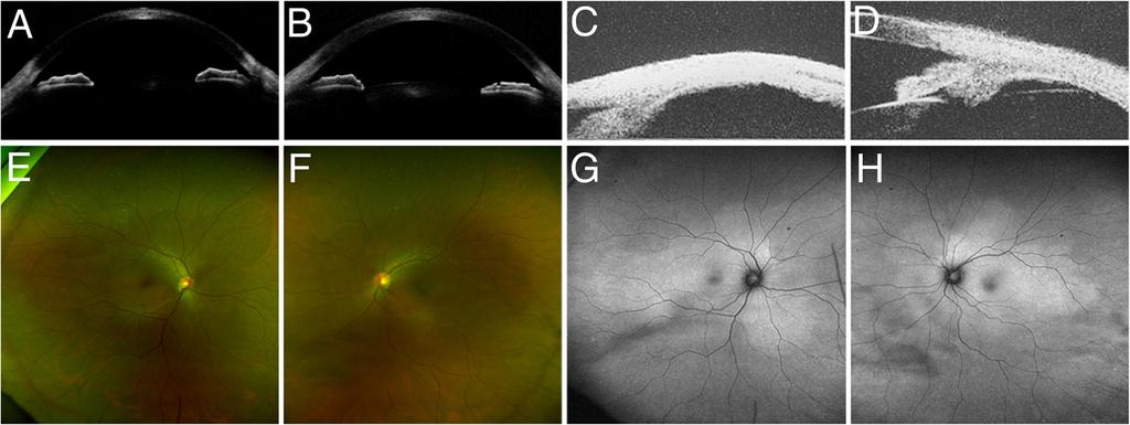 Kurobe et al. Journal of Ophthalmic Inflammation and Infection (2017) 7:16 Page 4 of 6 Fig. 4 Findings 7 months after the steroid tapering therapy. a, b Optical coherence tomography findings.