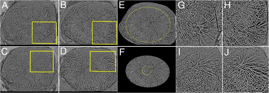 Kurobe et al. Journal of Ophthalmic Inflammation and Infection (2017) 7:16 Page 5 of 6 Fig. 6 Binarized images of wide-field indocyanine green angiograms before and after treatment.