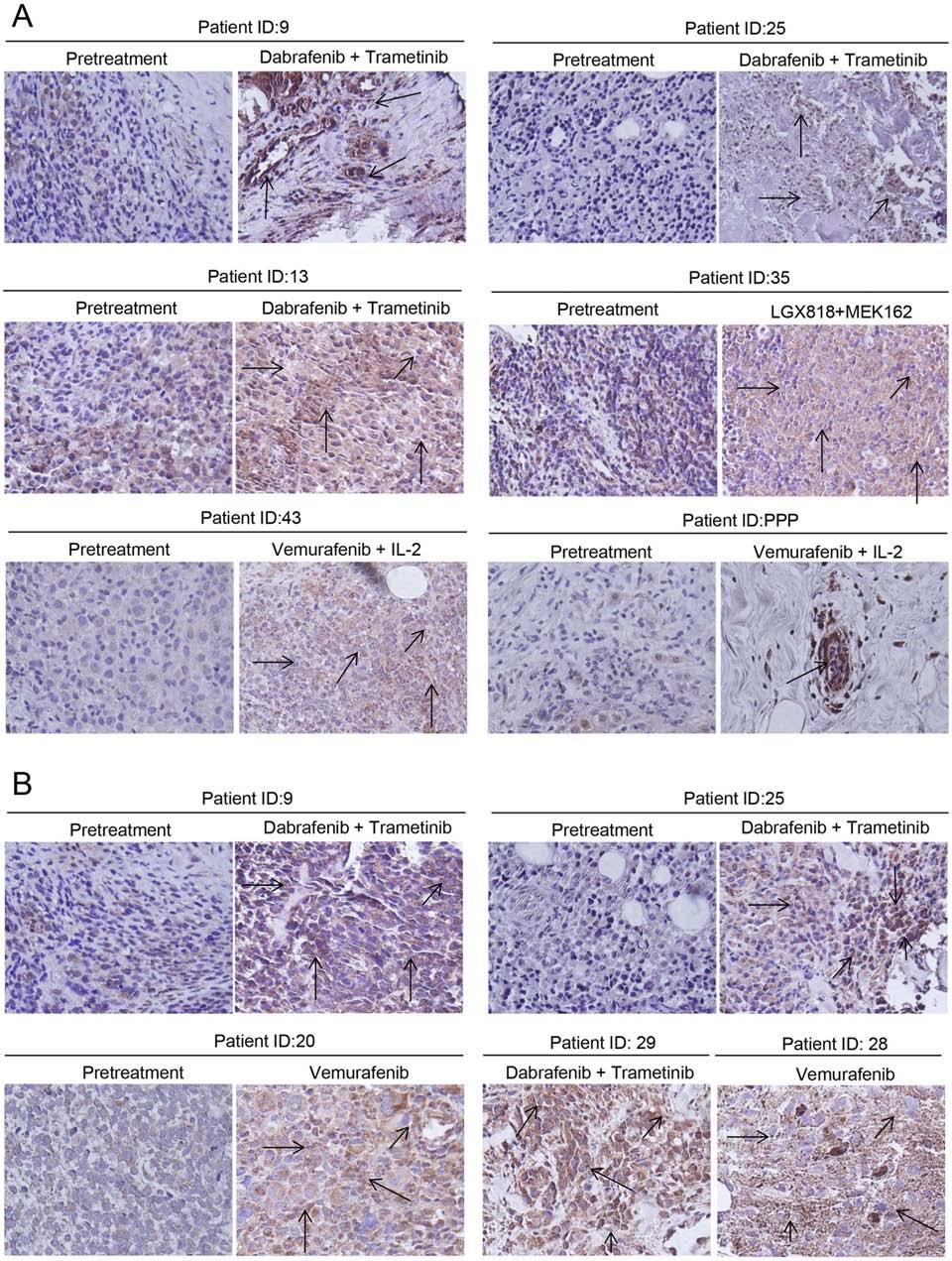 Figure 10: Tumor biopsy samples exhibited enhanced Mcl-1 expression in patients treated with BRAF inhibitor alone or in combination with MEK1/2 inhibitor.
