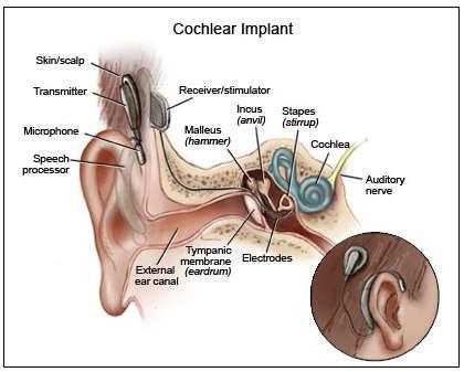 3. COCHLEAR IMPLANT 3.1 Functionality The cochlear implant s functionality depends on the joint capabilities of the internal and external components.