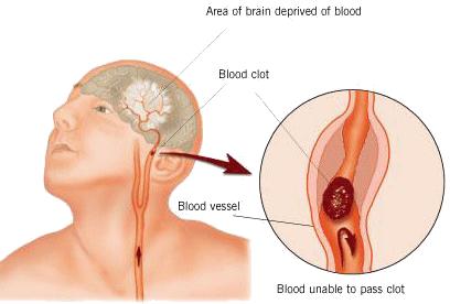 11. Where was the damage? Suppose a woman suffers a stroke (bleeding within the brain) and suffers some brain damage.