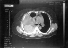 disease. A B Figure 1. A) Chest radiography and B) computed tomography of a patient with right pleural effusion.