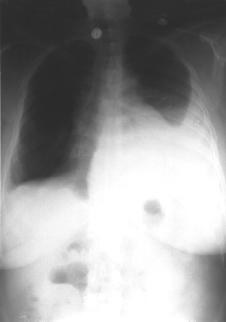 Figure 2. Chest radiography of the patient with left pleural effusion 7 years after presentation with right pleural effusion. Figure 3.