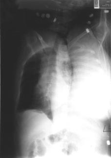 Dimitri 5 reported a case of massive idiopathic hemothorax in which thoracoscopic exploration showed no identifiable pathology or bleeding source and no further bleeding after tube drainage.