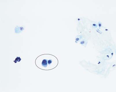 Strojan Flezar M / Urine and bladder washing cytology 209 FIGURE 1. Malignant cells of invasive urothelial carcinoma with cellular debris (necrosis) in the background (Papanicolaou, x400). FIGURE 2.