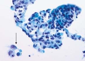 Strojan Flezar M / Urine and bladder washing cytology 213 A B C FIGURE 5. Mild cytological atypia of urothelial cells (arrow) in routine cytology bladder washing specimen (Papanicolaou, x400) (A).