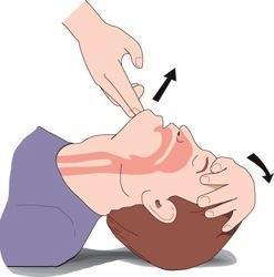 Airway - Check the person s mouth for any obstructions - Remove any obstructions - Once
