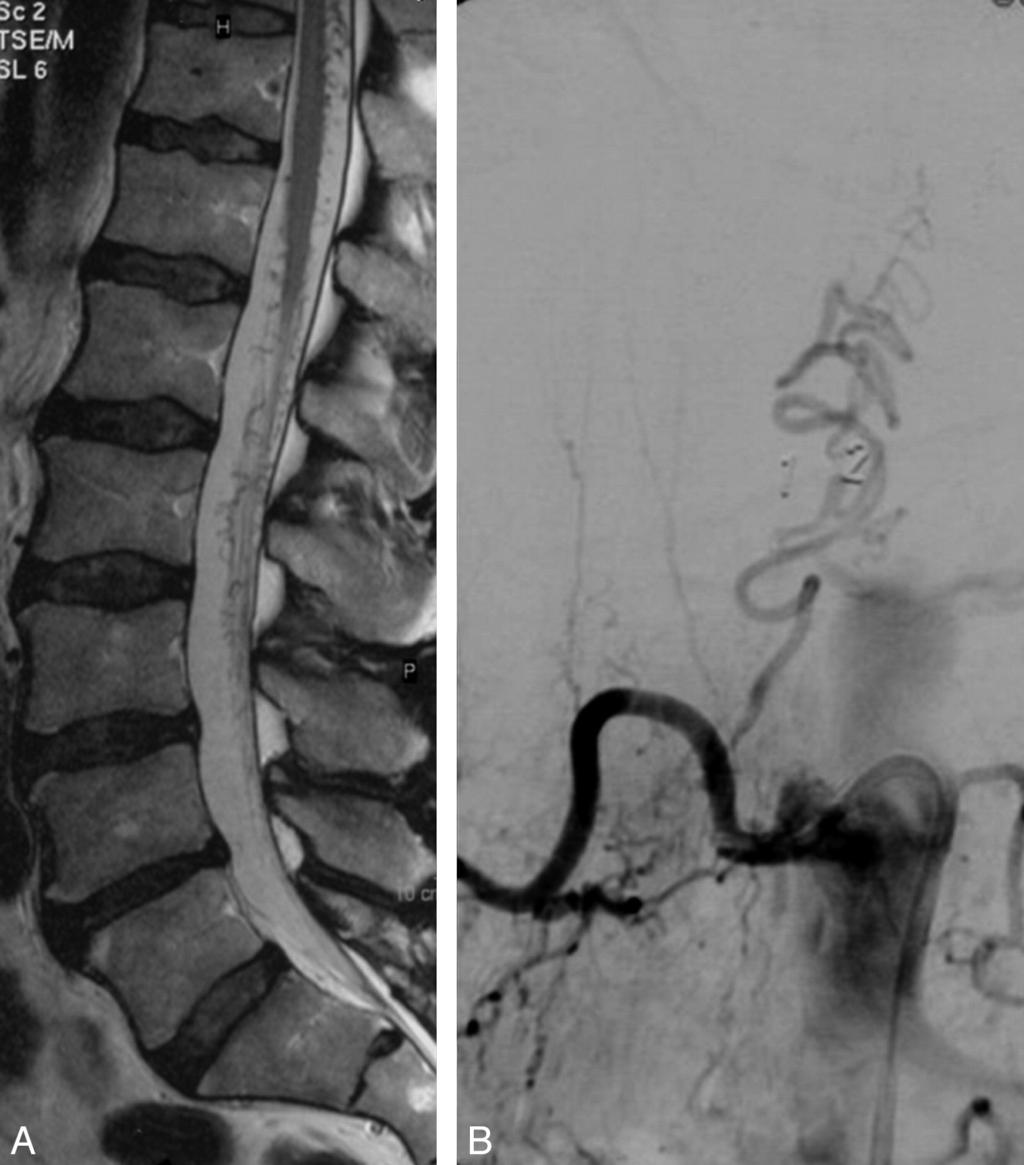 Fig 1. A 63-year-old man with nonspecific chronic lower back pain. A, MR imaging shows dilated radicular and perimedullary veins without myelopathy.