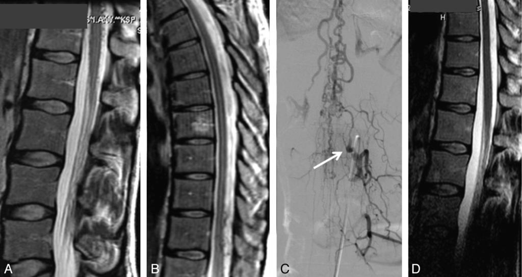 C, MR imaging 3 months after embolization of the fistula no longer shows the dilated radicular and perimedullary veins. Note L4-L5 disk herniation. Fig 3.