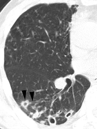 CT of Nontuberculous Mycobacterial Pulmonary Infection Fig. 4. (continued) 57-year-old man with Mycobacterium avium-intracellulare complex pulmonary infection with follow-up CT scans.