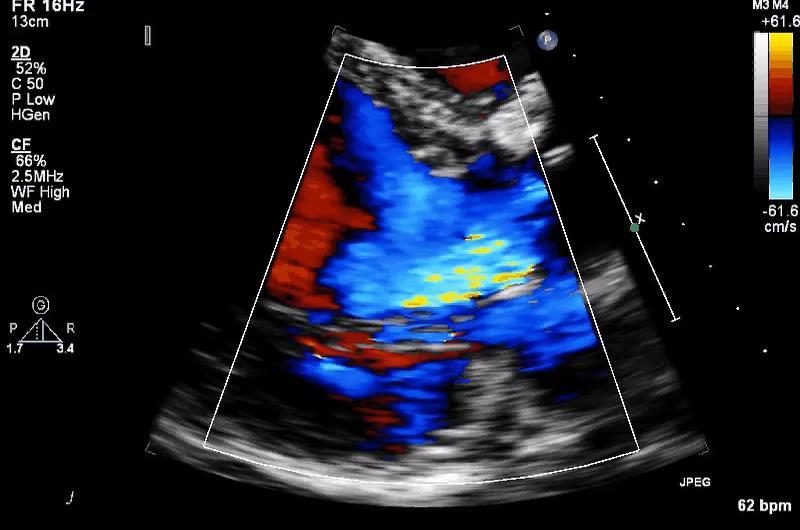 Case Presentation 48-year-old man with Severe aortic regurgitation Bicuspid aortic valve and aortic root dilatation