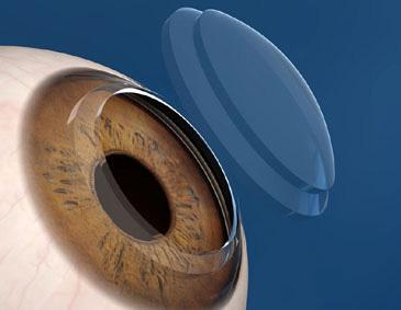 Figures 3A and 3B: Top hat shaped corneal graft. IntraLase software used. Images used with permission from Abbott Medical Optics. http://www.abbottmedicaloptics.