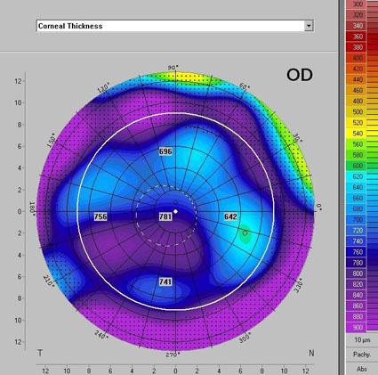 Note the presence of hyperdensity at the corneal