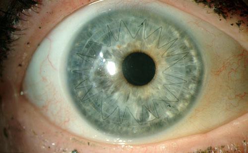 Figure 6: Right eye, post laser assisted keratopathy.