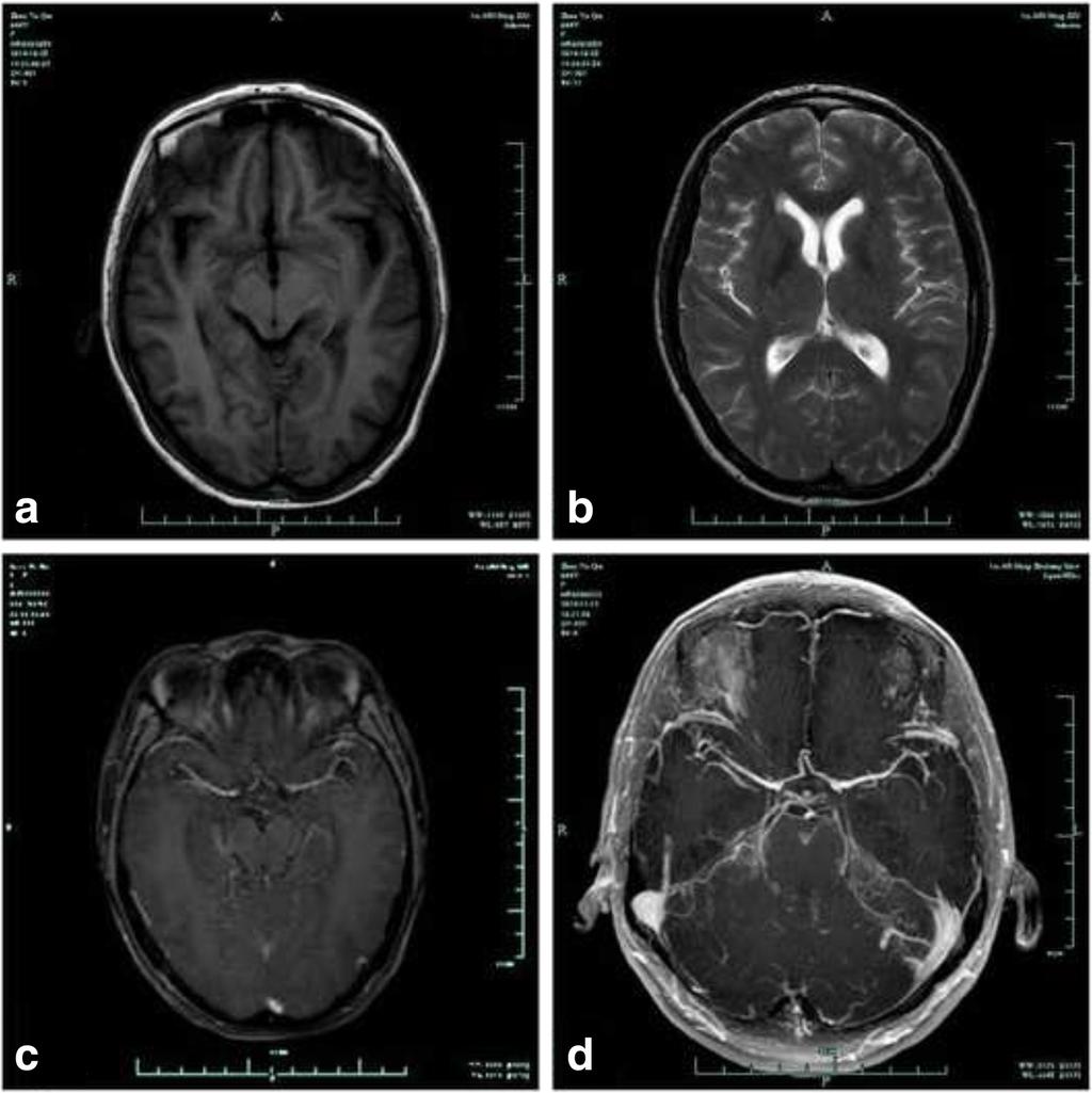 Pan et al. BMC Neurology (2016) 16:158 Page 2 of 6 Case presentation Case 1 A 44-year-old female was transferred to our department with a 1-month history of headache, nausea and vomiting.