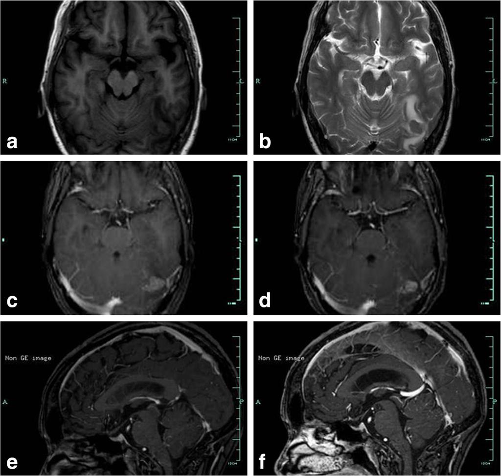 Pan et al. BMC Neurology (2016) 16:158 after being diagnosed with a space-occupying lesion in the left occipital lobe.