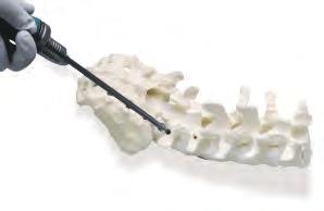 Degenerative Surgical Technique 1. Surgical Approach And Preparation After the patient is positioned in the customary manner, the spine is exposed via a midline or paraspinal incision.
