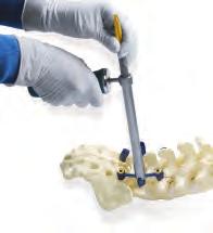 Spondy Reduction Technique Reduction Screws may be used in the presence of a low-grade spondylolisthesis.