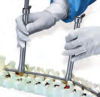 Both instruments permit intraoperative application of linear Distraction or Compression at any level.
