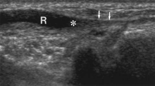 Fig. 5. Sonograms of 36-year-old woman with extension deficit of thumb (patient 2 in Table 1). Left side of images is proximal; right side, distal.