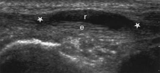 Sonogram in 37-year-old man with extension deficit of thumb (patient 3 in Table 1). Longitudinal view of extensor pollicis longus (EPL) shows empty sheath of EPL (r).
