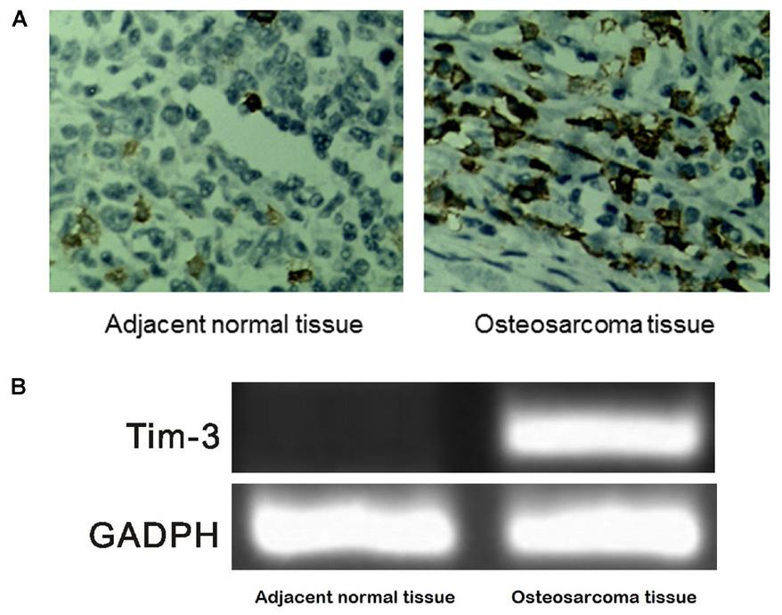 Tim-3 affects osteosarcoma proliferation via NF-kB and EMT 5 significantly higher in the osteosarcoma tissue compared to the para-carcinoma tissue (0.02 ± 0.00 vs 0.94 ± 0.02, P < 0.01; Figure 1B).