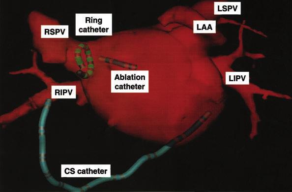 Additional ablation lines were created in the posterior left atrium and across the isthmus between the mitral annulus and the inferior portion of the circumferential ablation line surrounding the