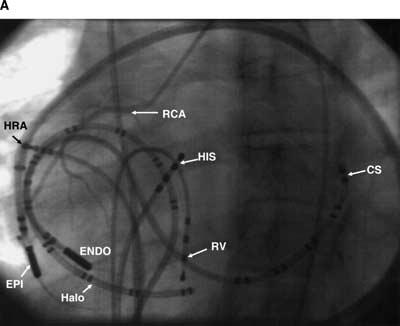Morady Catheter Ablation 127 Figure 1. Right-sided epicardial accessory pathway ablated using a transcutaneous pericardial approach.