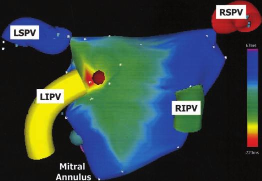 128 Journal of Cardiovascular Electrophysiology Vol. 15, No. 1, January 2004 Figure 2. Activation map of a focal atrial tachycardia created with a three-dimensional electroanatomic mapping system.