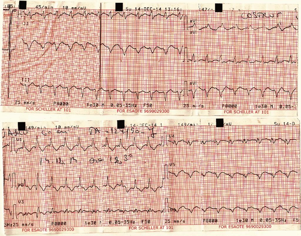 Figure 1. Twelve lead ECG during an episode of palpitations. The image shows a wide-qrs tachycardia with a RBBB morphology in V1 and negative complex in the inferior leads.