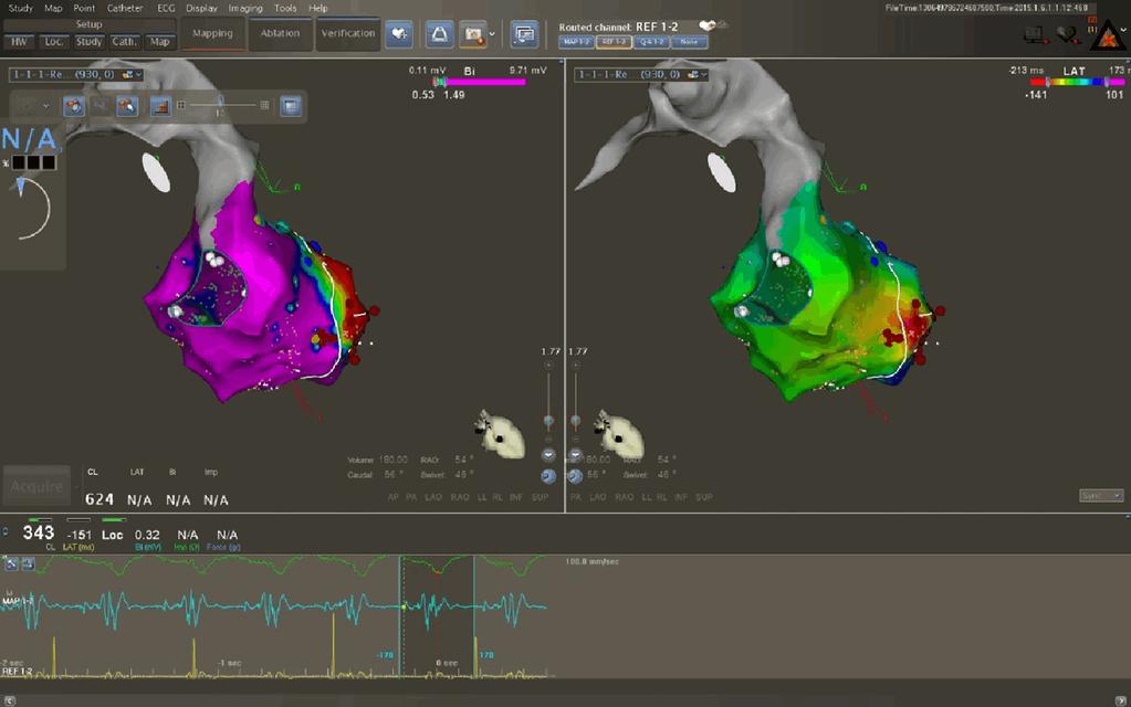 Figure 3. Three dimensional voltage map and activation map. Similar to Figure 2 but another incidence of view from behind the left ventricle.