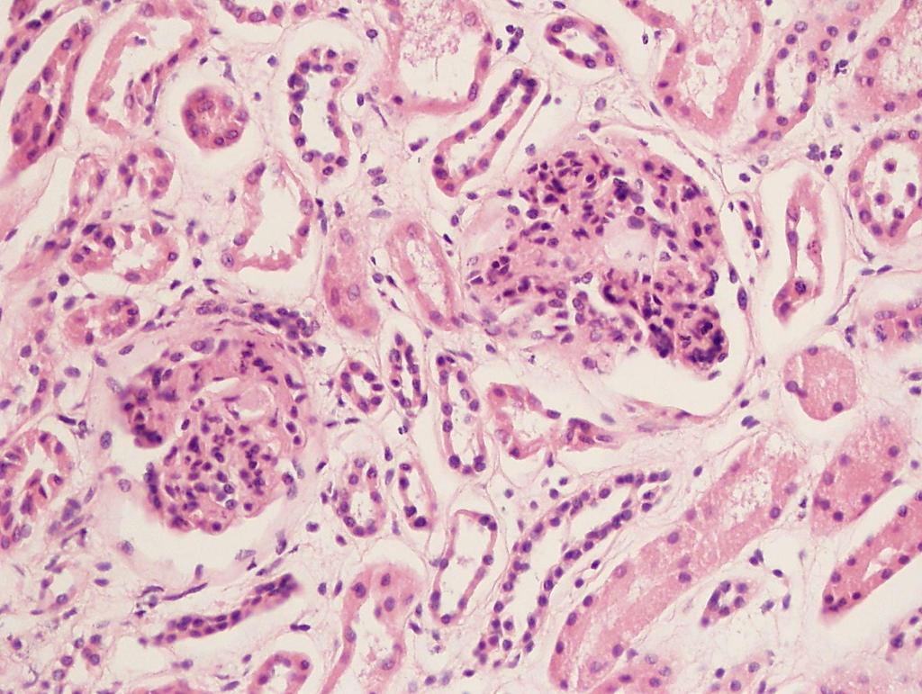 Antiphospholipid syndrome, trombotic microangiopathy - TTP/HUS, renal biopsy.