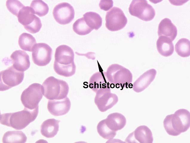 HUS criteria Thrombocytopenia - below 150x10 9 /l or a decrease of 25% compared to a baseline value Microangiopathic hemolytic anemia - Nonimmunologic hemolysis (anemia, bilirubin, LDH, haptoglobin)