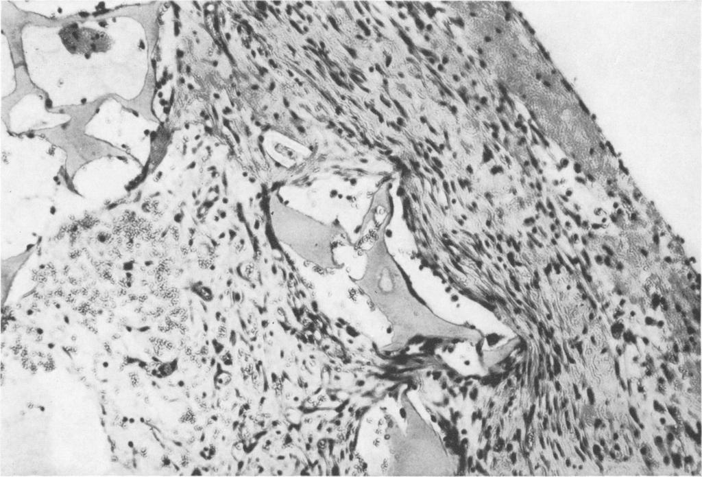 23 EHRLICH, TARVER AND HUNT Ann. Surg. * Feb. 1972 Vol. 175 * No. 2.. :.... FIG. 2. Histologic appearance of sponge taken from an animal treated by vitamin E alone. Outside of sponge is to the right.