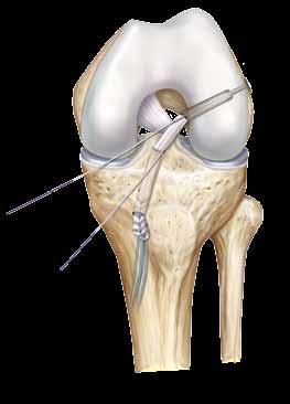 facilitates complete graft fill of short femoral sockets that are