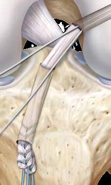 The graft will be completely seated when the mark on the graft reaches the femoral socket.