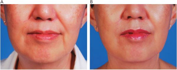 CHUA ET AL Figure 2. Before (A) and after (B) pictures showing significant improvement in mid and lower facial laxity 6 months after three infrared treatments. damage.