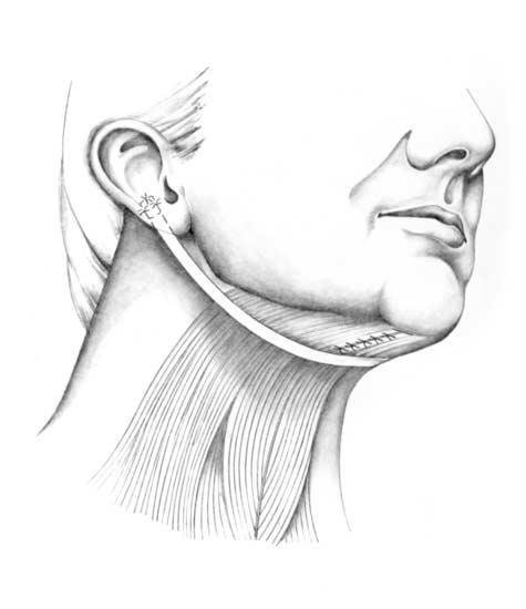 Figure 1. Right oblique view of the expanded polytetrafluoroethylene cervical sling in place. Note that the sling sutures are placed only postauricularly.
