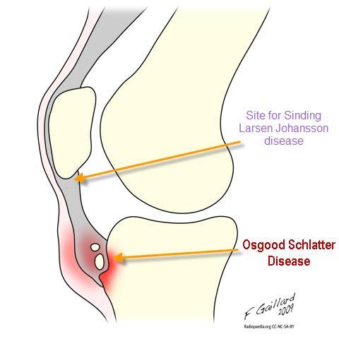 OSGOOD-SCHLATTER DISEASE Associated with repetitive knee extension