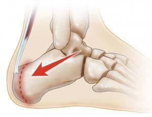 SEVER S DISEASE Heel pain is skeletally immature athlete Tenderness at the insertion