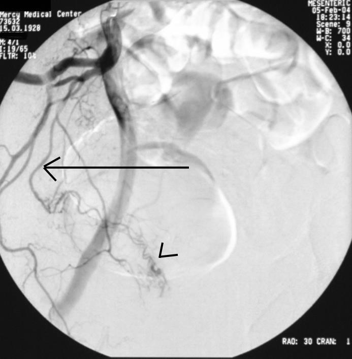 This is a right internal iliac arteriogram 30 degree RAO preembolization.