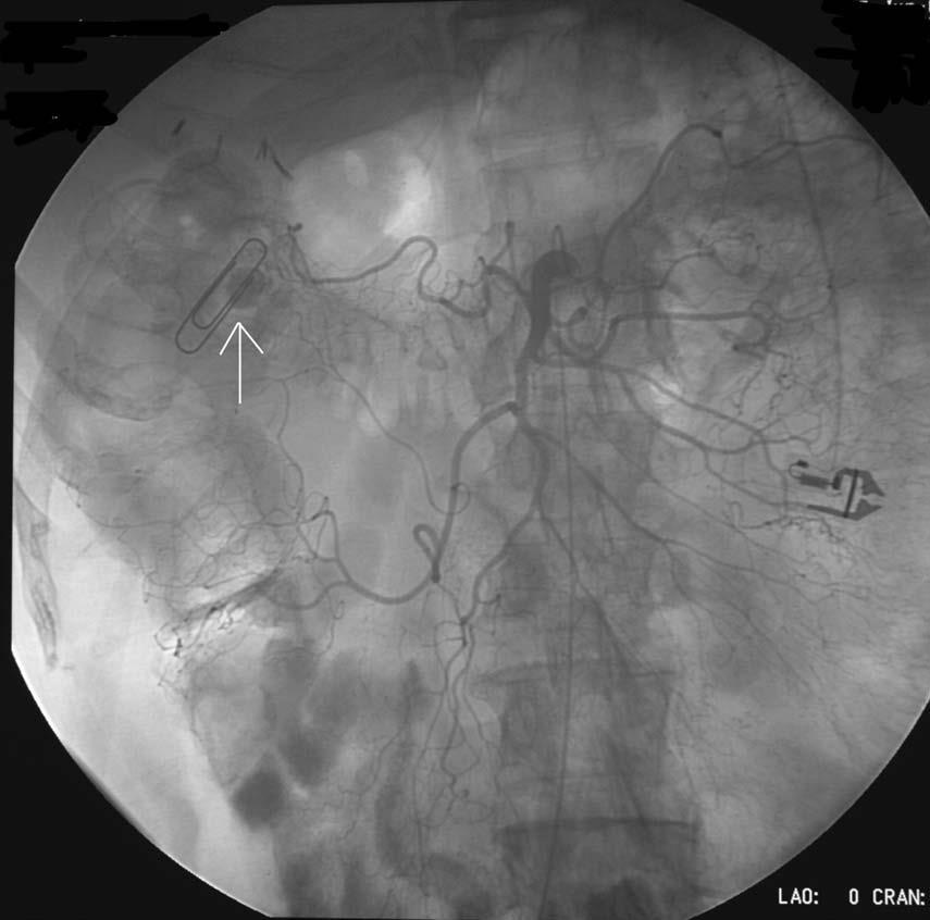 late phase Diverticular bleed and paperclip