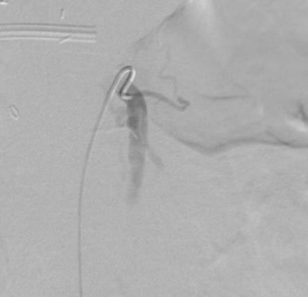 Selective SMA injection SMA Injection demonstrates a pseduoanerurysm in the region of the pancreatic postsurgical bed supplied by a collateral branch extending from the superior mesenteric artery to